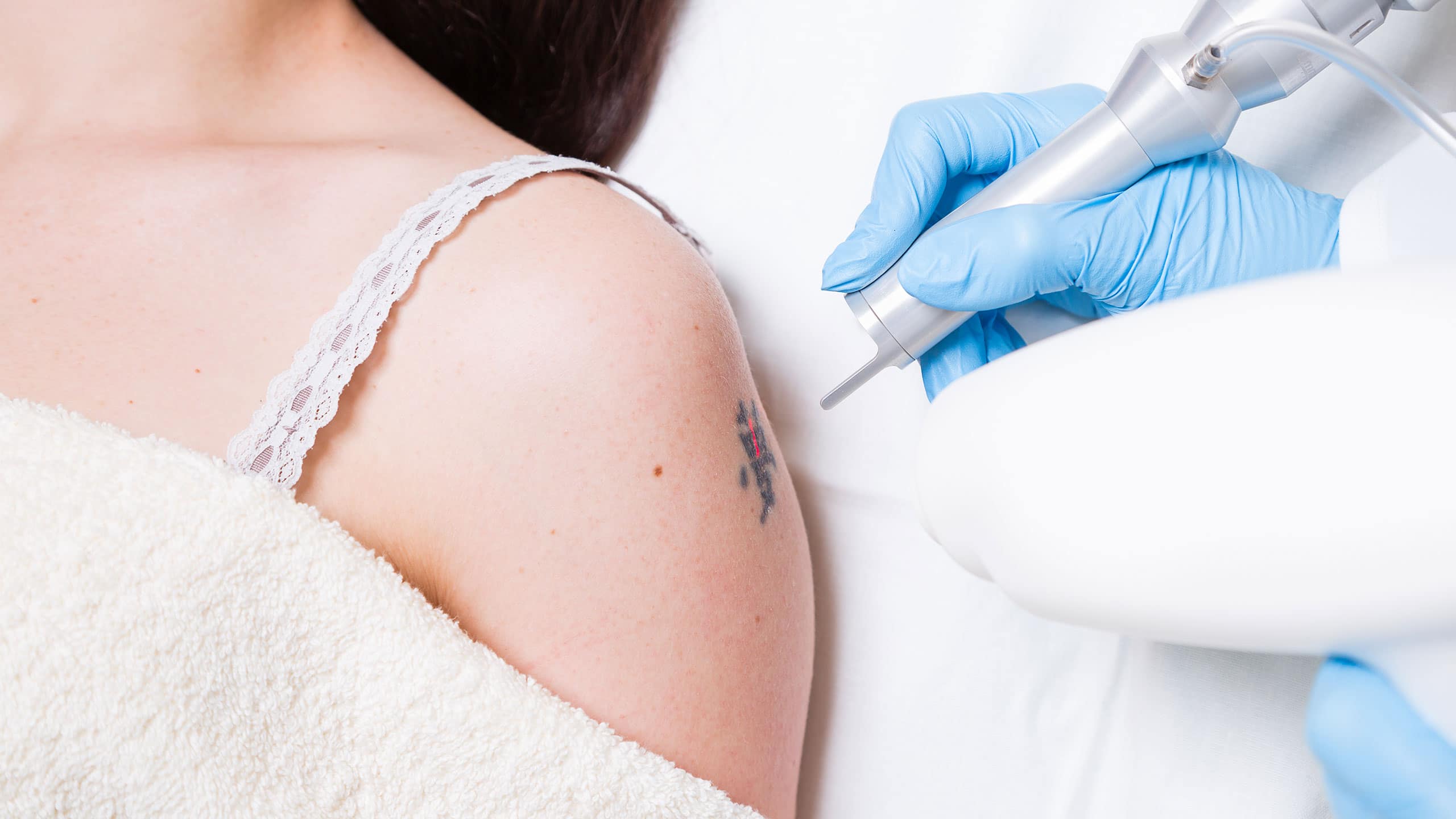 tattoo-removal